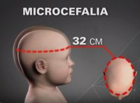 RO registrou 12 notificações para microcefalia desde 2013, diz Agevisa - Foto: Reprodução