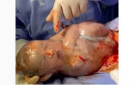 Bebê nasce empelicado em RO e vídeo viraliza: 'Foram ao meu médico pedir um parto como o meu' - Foto: Reprodução redes sociais