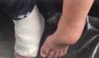 Adolescente autista fratura pé esquerdo e hospital engessa pé direito - Foto: Reprodução Rede Social