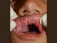 O sexo oral é a principal forma de transmissão do HPV pela boca - Foto: Reprodução