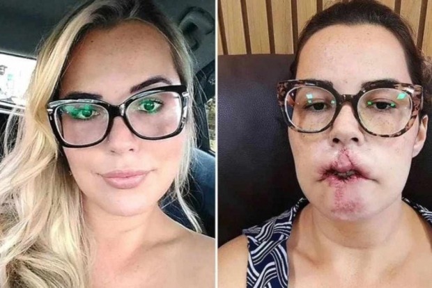 Mariana Michelini, 35 anos, fez uma harmonização facial em 2020. Seis meses depois do preenchimento (Foto: Reprodução)