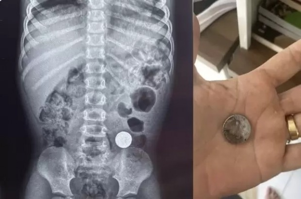 Criança de 3 anos engole bateria de lítio e é internada com dor abdominal em RO